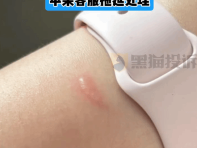 AppleWatch低温烫伤用户？苹果回应称产品无问题引热议