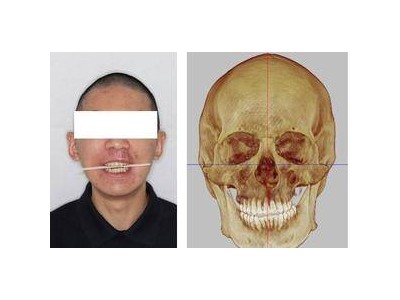 四川大学华西口腔医院完成全国首例自主研发3D打印钛板正颌手术