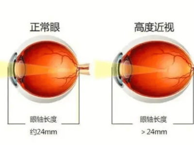 你知道高度近视的危害有哪些吗？